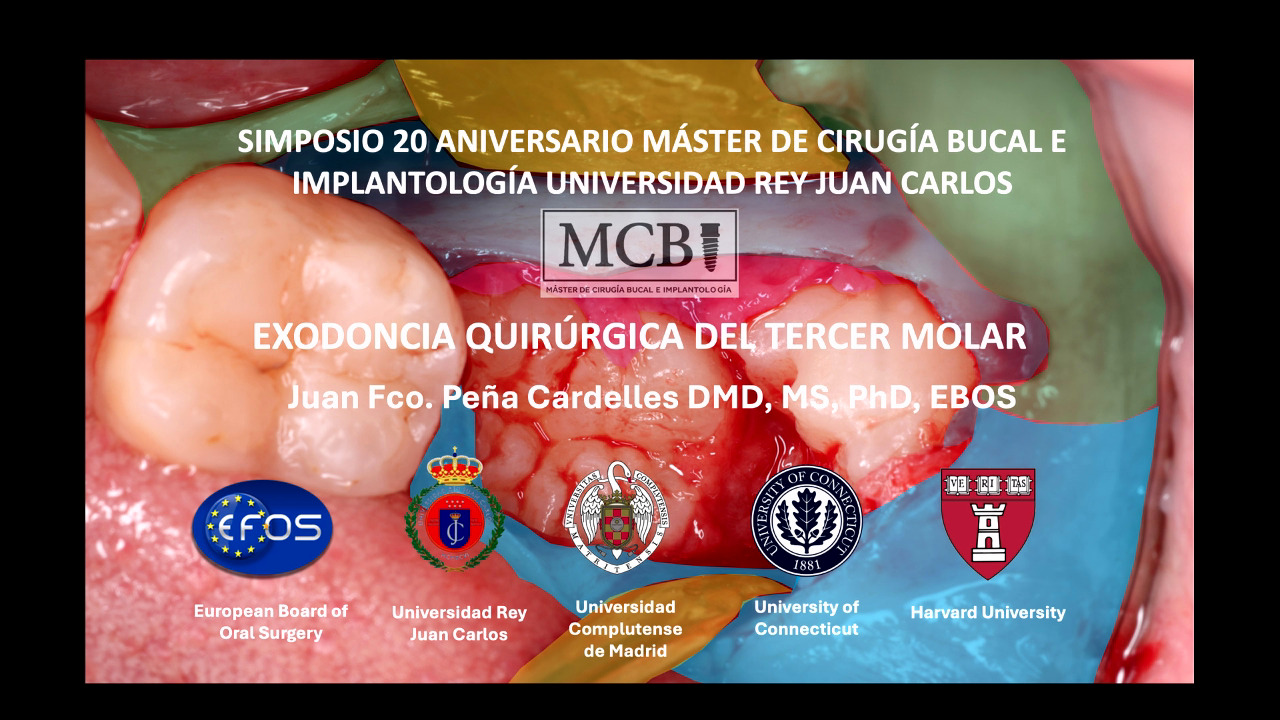 Juan Francisco Cardelles (URJC) -  Exodoncia quirúrgica de terceros molares. Estado del arte y flujos digitales